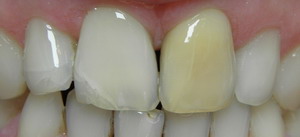 whitening dead teeth