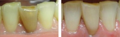 ząb martwy przebarwiony wybielanie przed i po