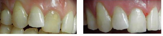 ząb martwy przebarwiony wybielanie przed i po