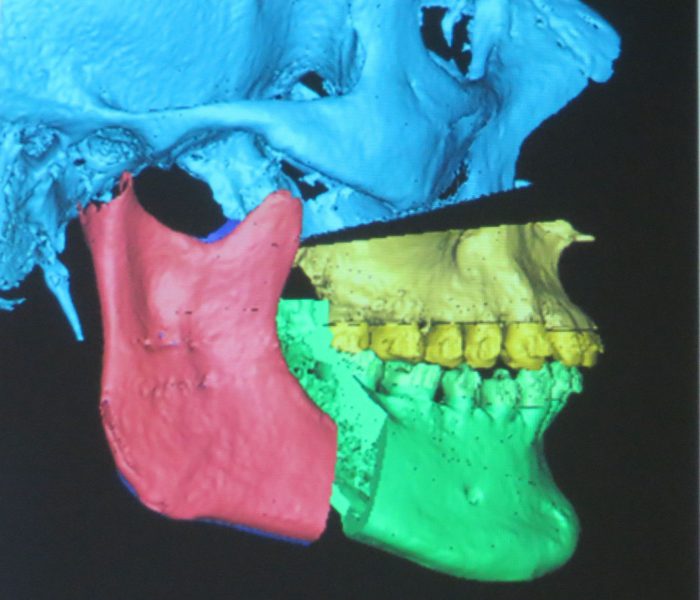 aparat ortodontyczny