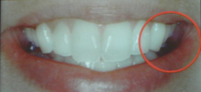 Po leczeniu ortodontycznym -pełny uśmiech