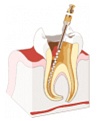 etapy_leczenie kanałowe ząb