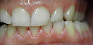 laterotruzja lewa starcie zębów