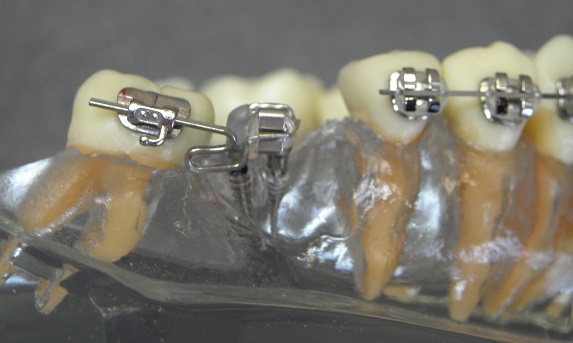 mini śruby ortodontyczne