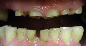 starcie patologiczne zębów