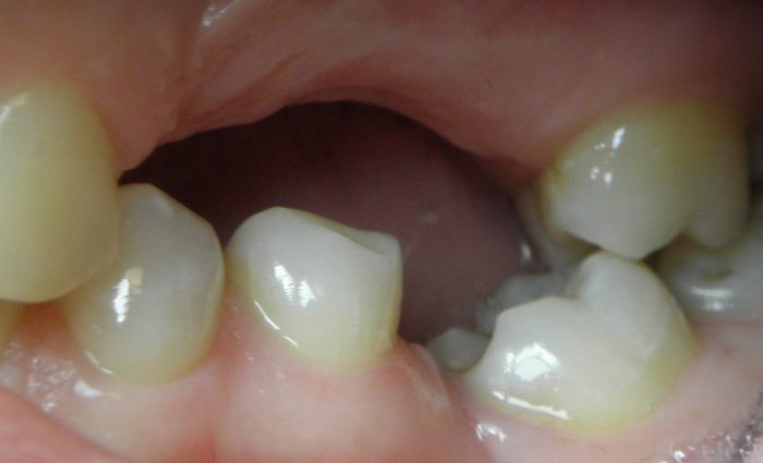 przechylenie zęba