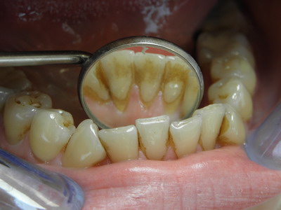 before ADENTIS teeth sandblasting