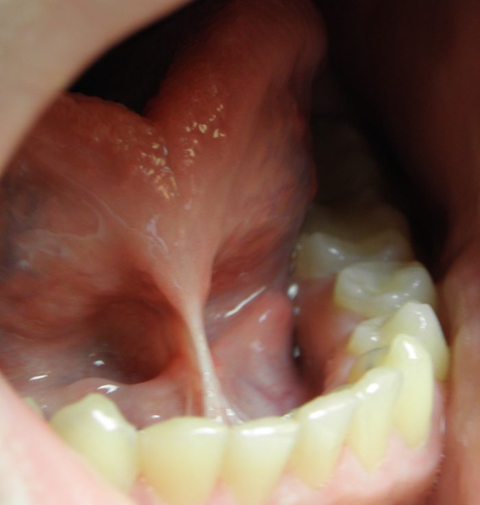 hypertrophied frenulum of the tongue