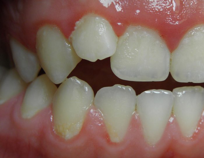 inflammation of the gums caused by bacterial plaque