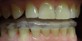 szyna relaksacyjna starte zęby