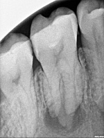 ząb zmiana okołowierzchołkowa
