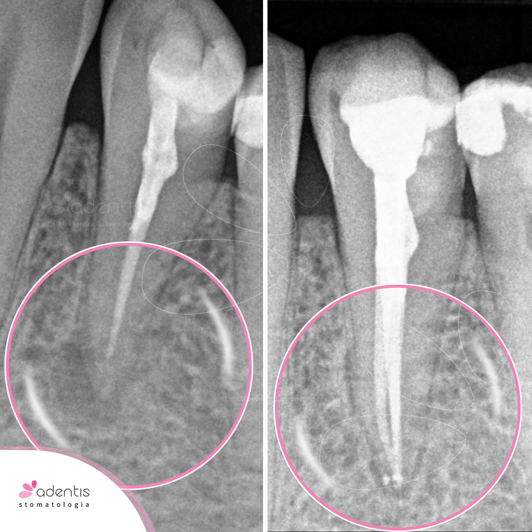 Leczenie Kanałowe Pod Mikroskopem Endodoncja Warszawa Ursynów Adentis 6144